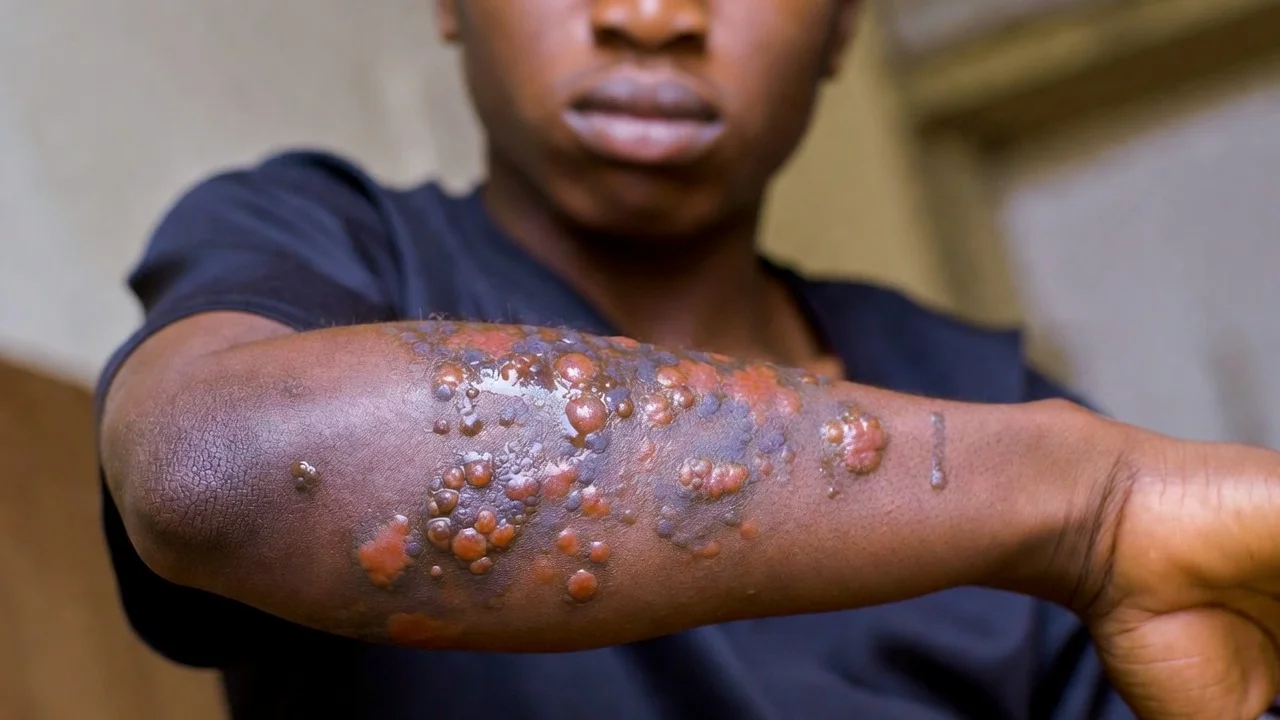 EU Scientists Bring Mpox to America - Exactly as Predicted in Their Own Lancet Paper